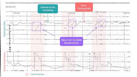 how to read the monitor at the hospital: a deep dive into the nuances of heart rate variability